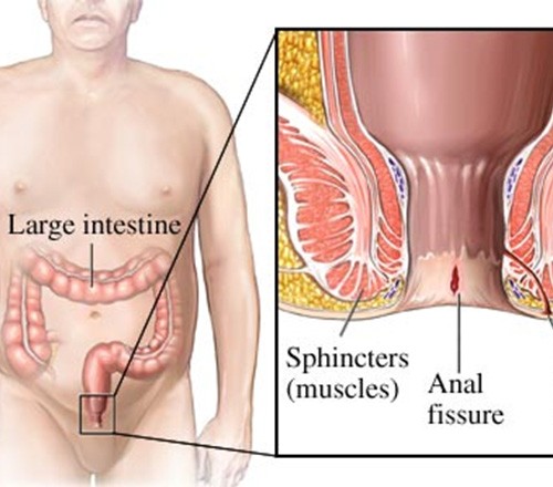 Anal Fissure