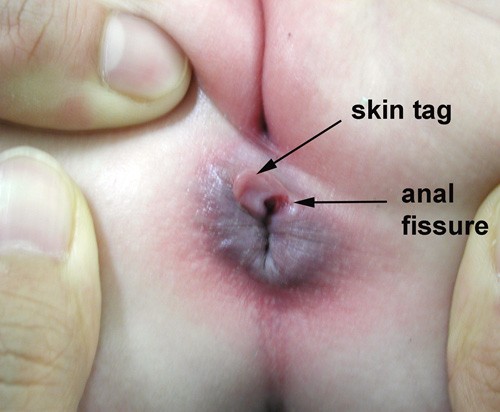 Anal Fissure